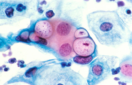 Мазок з chlamydia trachomatis під мікроскопом
