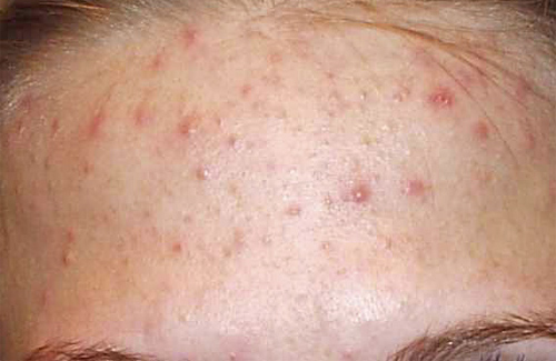 Демодекоз — це інвазійна хвороба шкіри