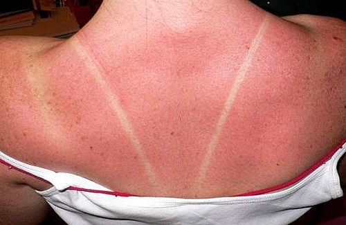 Что делать, если кожа лица сгорает и обгорает на солнце — первая помощь при ожогах