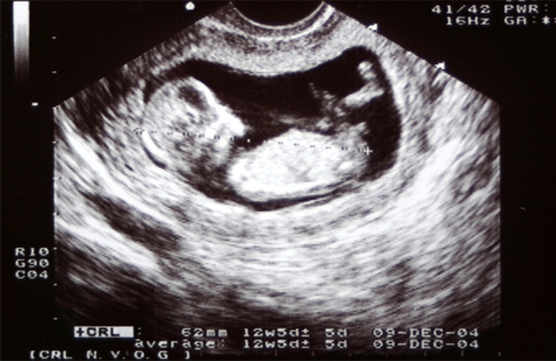 УЗД на 11 тижні вагітності