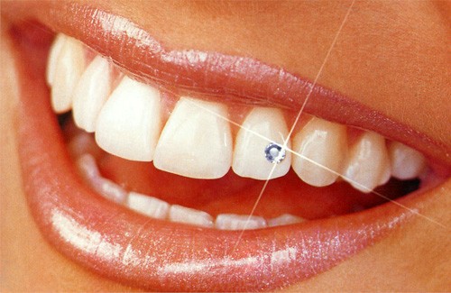 Скайси — стрази, які приклеюються до передніх зубів для створення ефекту сяючої посмішки